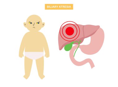 Yeni doğmuş bir vücutta sarılık belirtileri. Sarı deri, gözler ve mukoza zarları, karaciğer yetmezliği, safra kanalı ve safra kesesi anatomisi. Hepatoloji ve pediatri konsepti düz vektör tıbbi çizim.