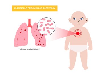 Klebsiella pnömoni posteri. Gramnegatif, kapsülleşmiş, bebek ciğerlerinde fırsatçı patojen. Zatürree, sepsis, karaciğer apsesi. Antibiyotik direnci, biyo-film, bakteri vektör çizimi.