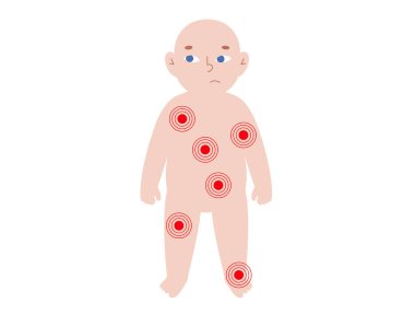 Kırmızı lekeli çocuk silueti acıyı, enfeksiyonu ya da deri durumunu simgeliyor. Hastalığı, rahatsızlığı, iltihabı veya viral hastalığı, düz vektör illüstrasyonunu gösteren pediatrik bebek diyagramı