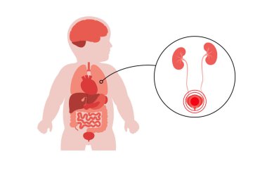 Böbrekleri ve mesanesi olan çocuk silueti. Bebek bedeninde idrar yolu enfeksiyonu, reflü, hidronefroz, sistit, böbrek rahatsızlıkları olan çocuk hastalıkları gösteren bir pediatrik vektör. Bebek silueti tıbbi illüstrasyon
