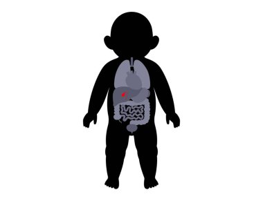 Safra kesesi olan çocuk silueti anatomik pozisyonda görünüyor. Pediatrik vektör, bebek vücudunda safra akışı, safra taşı, kolestaz ve konjenital safra kesesi bozukluklarını vurguluyor.