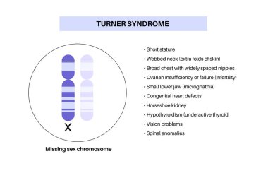 Turner sendromu bir kromozom X monosom biyolojik posteri kayıp. Gen bozukluğunun ana belirtileri, gelişimsel gecikme, tıbbi bilgiler. DNA hastalığı vektör çizimi, genetik mutasyon kavramı