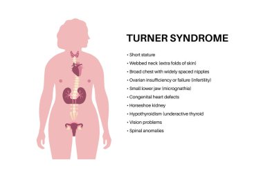 Turner sendromu belirtileri, kadın siluetinde kusurlu organlar. Kısa boylu, perdeli boyun, kalp ve yumurtalık bozuklukları, hormon dengesizliği. Pediatrik genetik bozukluk düz vektör tıbbi çizim