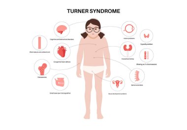 Turner sendromu belirtileri, kızların vücudunda kusurlu organlar. Kısa boylu, perdeli boyun, kalp ve yumurtalık bozuklukları, hormon dengesizliği. Pediatrik genetik bozukluk düz vektör tıbbi çizim