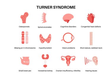 Turner sendromu semptomları, kusurlu organlar ve gen anomalileri ikonları. Kısa boylu, perdeli boyun, kalp ve yumurtalık bozuklukları, hormon dengesizliği. Pediatrik bozukluk diyagramı vektör tıbbi çizimi