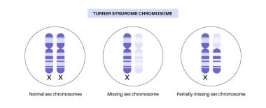 Turner sendromu biyolojik posteri, sağlıklı seks kromozomu ve bir tane eksik X monostomi eşleşmesi. Gen bozukluğu, gelişimsel gecikme, tıbbi bilgiler. DNA vektör illüstrasyonu, genetik hastalık vektörü