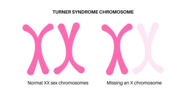 Turner sendromu biyolojik posteri, sağlıklı seks kromozomu ve bir tane eksik X monostomi eşleşmesi. Gen bozukluğu, gelişimsel gecikme, tıbbi bilgiler. DNA vektör illüstrasyonu, genetik hastalık vektörü