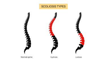 Omurga, kifoz ve lordosis karşılaştırması normal. Skolyoz konsepti. İnsan omurga anatomisi ve duruş koşulları. Omurga deformasyonları ve eğrilik tipleri düz vektör çizimi, omurga medikal diyagramı