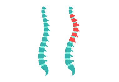Omurga eğrisi ve sağlıklı hizalama. Skolyoz deformasyonu, omurga bozukluğu, tıbbi yanal anatomi diyagramı. Eklemler ve kıkırdaklar. Ortopedik konsept, kifoz dejenerasyonu tıbbi vektör çizimi