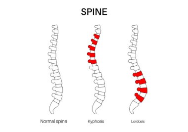Omurga, kifoz ve lordosis karşılaştırması normal. Skolyoz konsepti. İnsan omurga anatomisi ve duruş koşulları. Omurga deformasyonları ve eğrilik tipleri düz vektör çizimi, omurga medikal diyagramı