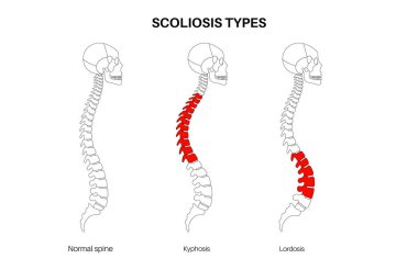 Omurga, kifoz ve lordosis karşılaştırması normal. Skolyoz konsepti. İnsan omurgası ve kafatası anatomisi, duruş koşulları. Omurga deformasyonları, eğrilik tipleri ana hatlı vektör çizimi, omurga diyagramı
