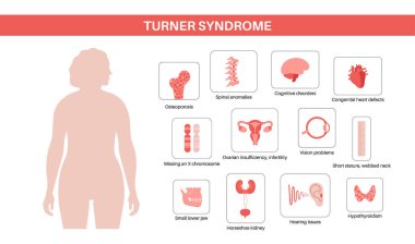Turner sendromu belirtileri, kadın siluetinde kusurlu organlar. Kısa boylu, perdeli boyun, kalp ve yumurtalık bozuklukları, hormon dengesizliği. Pediatrik genetik bozukluk düz vektör tıbbi çizim