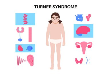 Turner sendromu belirtileri, kızların vücudunda kusurlu organlar. Kısa boylu, perdeli boyun, kalp ve yumurtalık bozuklukları, hormon dengesizliği. Pediatrik genetik bozukluk düz vektör tıbbi çizim