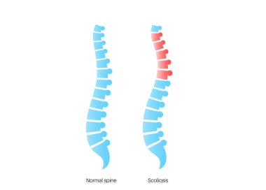 Omurga eğrisi ve sağlıklı hizalama. Skolyoz deformasyonu, omurga bozukluğu, tıbbi yanal anatomi diyagramı. Eklemler ve kıkırdaklar. Ortopedik konsept, kifoz dejenerasyonu tıbbi vektör çizimi