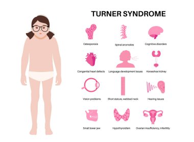 Turner sendromu belirtileri, kızların vücudunda kusurlu organlar. Kısa boylu, perdeli boyun, kalp ve yumurtalık bozuklukları, hormon dengesizliği. Pediatrik genetik bozukluk düz vektör tıbbi çizim