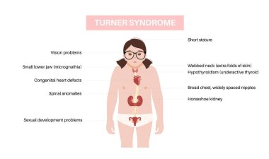 Turner sendromu belirtileri, genç kız vücudunda kusurlu organlar. Kısa boylu, perdeli boyun, kalp ve yumurtalık bozuklukları, hormon dengesizliği. Pediatrik genetik bozukluk düz vektör tıbbi çizim