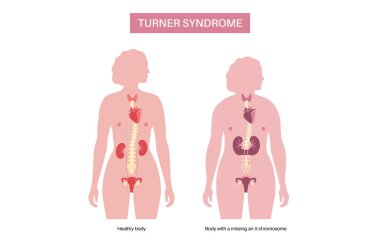 Turner sendromu belirtileri, kadın siluetinde kusurlu ve sağlıklı organlar. Kısa boylu, perdeli boyun, kalp ve yumurtalık bozuklukları, hormon dengesizliği. Pediatrik genetik bozukluk vektör çizimi
