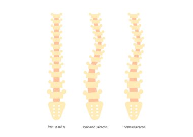Sağlıklı omurga, kombine ve göğüs skolyozu karşılaştırma posteri. Omurga anatomisi, sırt duruşu. Omurga deformasyonları ve eğrilik türleri vektör illüstrasyonu, omurga medikal diyagramı
