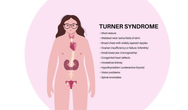 Turner sendromu belirtileri, kadın siluetinde kusurlu organlar. Kısa boylu, perdeli boyun, kalp ve yumurtalık bozuklukları, hormon dengesizliği. Pediatrik genetik bozukluk düz vektör tıbbi çizim