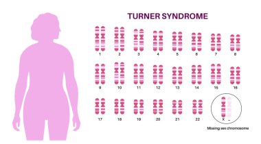 Turner sendromu karyotip diyagramı, hastalıklı kadın vücudu. 23 insan kromozom çifti, bir eksik cinsiyet kromozomu, X monostomisi. Genetik bozukluk konsepti, tıbbi bilgi, DNA vektör çizimi