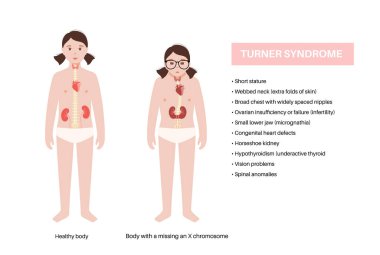 Turner sendromu belirtileri, kız siluetinde kusurlu ve sağlıklı organlar. Kısa boylu, perdeli boyun, kalp ve yumurtalık bozuklukları, hormon dengesizliği. Pediatrik genetik bozukluk vektör çizimi