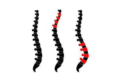 Omurga, kifoz ve lordosis karşılaştırması normal. Skolyoz konsepti. İnsan omurga anatomisi ve duruş koşulları. Omurga deformasyonları ve eğrilik tipleri düz vektör çizimi, omurga medikal diyagramı