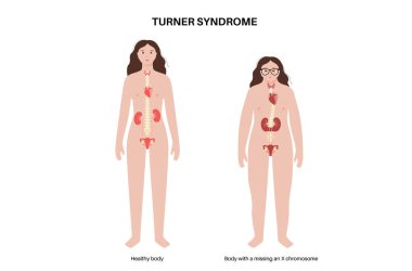 Turner sendromu belirtileri, kadın siluetinde kusurlu ve sağlıklı organlar. Kısa boylu, perdeli boyun, kalp ve yumurtalık bozuklukları, hormon dengesizliği. Pediatrik genetik bozukluk vektör çizimi