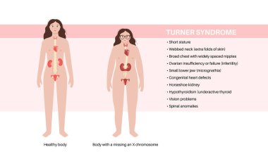 Turner sendromu belirtileri, kadın siluetinde kusurlu ve sağlıklı organlar. Kısa boylu, perdeli boyun, kalp ve yumurtalık bozuklukları, hormon dengesizliği. Pediatrik genetik bozukluk vektör çizimi