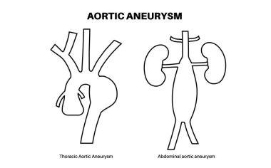Abdominal Aort Anevrizması ve Torasik Aort Anevrizması. Göğüste ve karnının alt kısmında yüksek tansiyon var. Tıbbi diyagram, insan vasküler anatomisi düz vektör çizimi