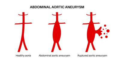 Abdominal aort anevrizması ve sağlıklı aort yırtılması. Acı ve basınç, şişkinlik ya da iltihap insan vücudunda. Abdominal aortun genişlemiş kısmı. Genişlemiş kan damarları vektör çizimi
