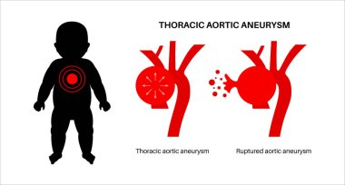 Bebeğin vücudunda torasik aort anevrizması yırtılmış. Acı, şişkinlik ya da yeni doğmuş siluette iltihap. Göğüs aortunun genişletilmiş kısmı. Çocuk vektöründeki genişlemiş kan damarlarıyla tıbbi diyagram