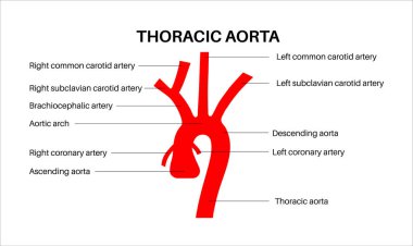 Torasik aort anatomisi. Etiketlenmiş diyagram, yükselen ve alçalan aortaları ve aort kemerini gösteriyor. Ana dallar arasında brachiocephalic gövde, sol ve sağ ortak karotidler ve sol subklavyen arter bulunmaktadır.