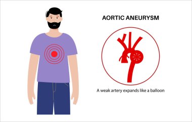 Erkek vücudunda torasik aort anevrizması. Kalp rahatsızlığı. Ağrı, basınç, göğüste iltihap. Göğüs aortunun genişletilmiş kısmı. Tıbbi diyagram, genişlemiş kan damarları vektör çizimi
