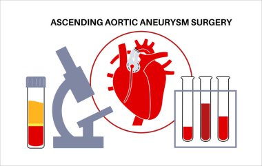 Torasik aort anevrizması açık ameliyat. Cerrah, genişlemiş aort bölümünü sentetik greftle onarıyor ya da değiştiriyor. Kardiyovasküler prosedür, aort onarımı, hastane operasyon vektör illüstrasyonu