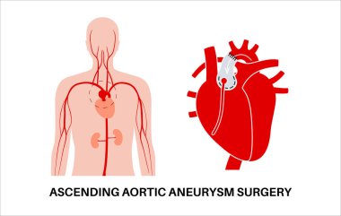 Torasik aort anevrizması açık ameliyat. Cerrah, genişlemiş aort bölümünü sentetik greftle onarıyor ya da değiştiriyor. Kardiyovasküler prosedür, aort onarımı, hastane operasyon vektör illüstrasyonu