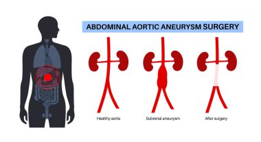 Abdominal aort anevrizması için açık ameliyat. Abdominal aortun açığa çıktığı karın kesiği. Zayıf aort segmenti medikal düz vektör illüstrasyonunun yerine sentetik bir doku yerleştirilir.