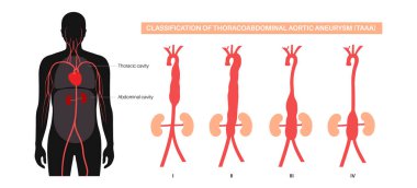 Torakoabdominal aort anevrizması sınıflandırma posteri. Göğüs ve karın aortu boyunca anevrizmanın genişliği. Farklı cerrahi yaklaşımlar ve riskleri değerlendirmek, düz vektör tıbbi illüstrasyon