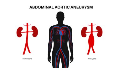 Abdominal aort anevrizması ve insan vücudunda sağlıklı aort. Karın bölgesinin alt kısmında yüksek tansiyon veya iltihap var. Tıbbi diyagram, insan vasküler anatomi vektörü çizimi