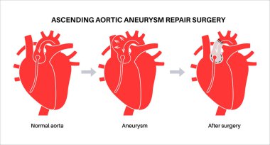 Torasik aort anevrizması açık ameliyat. Cerrah, genişlemiş aort bölümünü sentetik greftle onarıyor ya da değiştiriyor. Kardiyovasküler prosedür, aort onarımı, hastane operasyon vektör illüstrasyonu