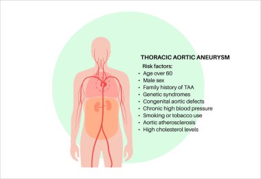 İnsan vücudunda torasik aort anevrizması. Ana risk faktörleri. Ağrı, yüksek tansiyon, göğüste iltihap. Göğüs aortunun genişletilmiş kısmı. Tıbbi diyagram, genişlemiş kan damarları vektörü