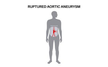 Erkek siluetinde yırtılmış abdominal aort anevrizması. Acı ve basınç, şişkinlik ya da iltihap insan vücudunda. Abdominal aortun genişlemiş kısmı. Genişlemiş kan damarları tıbbi taşıyıcı şeması
