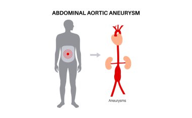 İnsan vücudunda abdominal aort anevrizması. Karın aortunda yüksek tansiyon. Karın bölgesinde iltihaplanma var. Tıbbi diyagram, insan vasküler anatomi vektörü çizimi