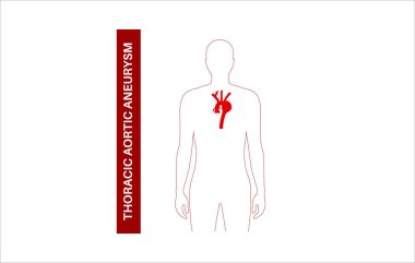 İnsan vücudunda torasik aort anevrizması. Göğüs bölgesinde ağrı, şişkinlik ya da iltihap. Göğüs aortunun genişletilmiş kısmı. Kan damarlarının genişlemesiyle ilgili tıbbi diyagram düz vektör çizimi