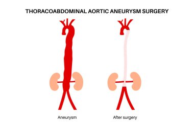 Göğüs ve karın aortunu etkileyen anevrizmanın cerrahi onarımı. Zayıf aort parçasının yerini almak için açık ya da melez yaklaşımı. Düz vektör çizimini önlemek için acil vasküler prosedür