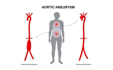 Abdominal Aort Anevrizması ve Torasik Aort Anevrizması. Göğüste ve karnının alt kısmında yüksek tansiyon var. Tıbbi diyagram, insan vasküler anatomisi düz vektör çizimi