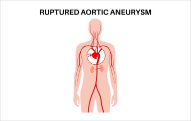 İnsan vücudunda yırtılmış torasik aort anevrizması. Yüksek tansiyon, erkek siluetinde iltihap. Göğüs aortunun genişletilmiş kısmı. Genişlemiş kan damarları diyagramı, tıbbi düz vektör.