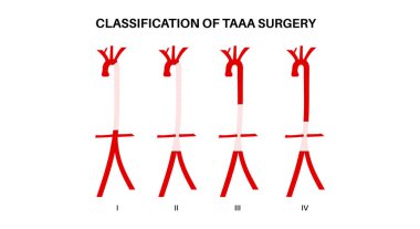 Torakoabdominal aort anevrizması cerrahi sınıflandırması. Göğüs ve karın aortu boyunca anevrizmanın genişliği. Farklı cerrahi yaklaşımlar ve riskleri değerlendirmek, düz vektör tıbbi illüstrasyon