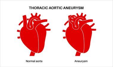 İnsan vücudunda torasik aort anevrizması. Kalp rahatsızlığı. Ağrı, basınç, göğüste iltihap. Göğüs aortunun genişletilmiş kısmı. Tıbbi diyagram, genişlemiş kan damarları vektör çizimi
