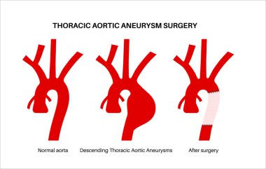Torasik aort anevrizması açık ameliyat. Cerrah, genişlemiş aort bölümünü sentetik greftle onarıyor ya da değiştiriyor. Kardiyovasküler prosedür, aort onarımı, hastane operasyon vektör illüstrasyonu