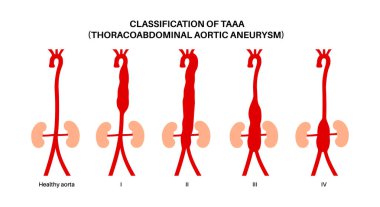 Torakoabdominal aort anevrizması sınıflandırma posteri. Göğüs ve karın aortu boyunca anevrizmanın genişliği. Farklı cerrahi yaklaşımlar ve riskleri değerlendirmek, düz vektör tıbbi illüstrasyon
